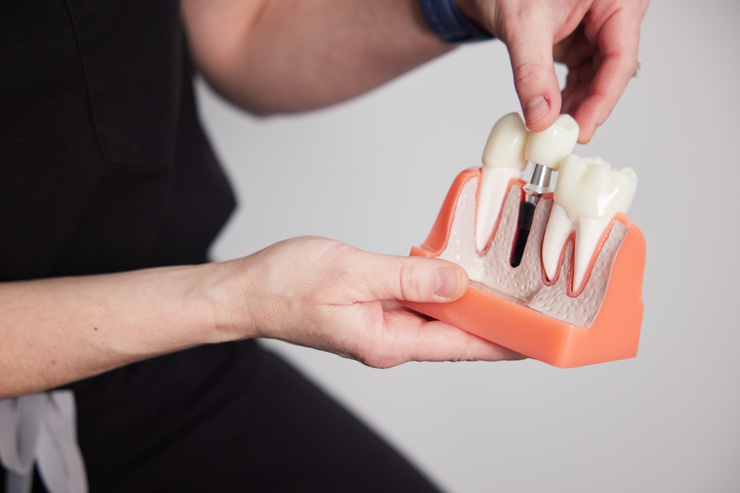 dentist showing a model of dental implants to a patient