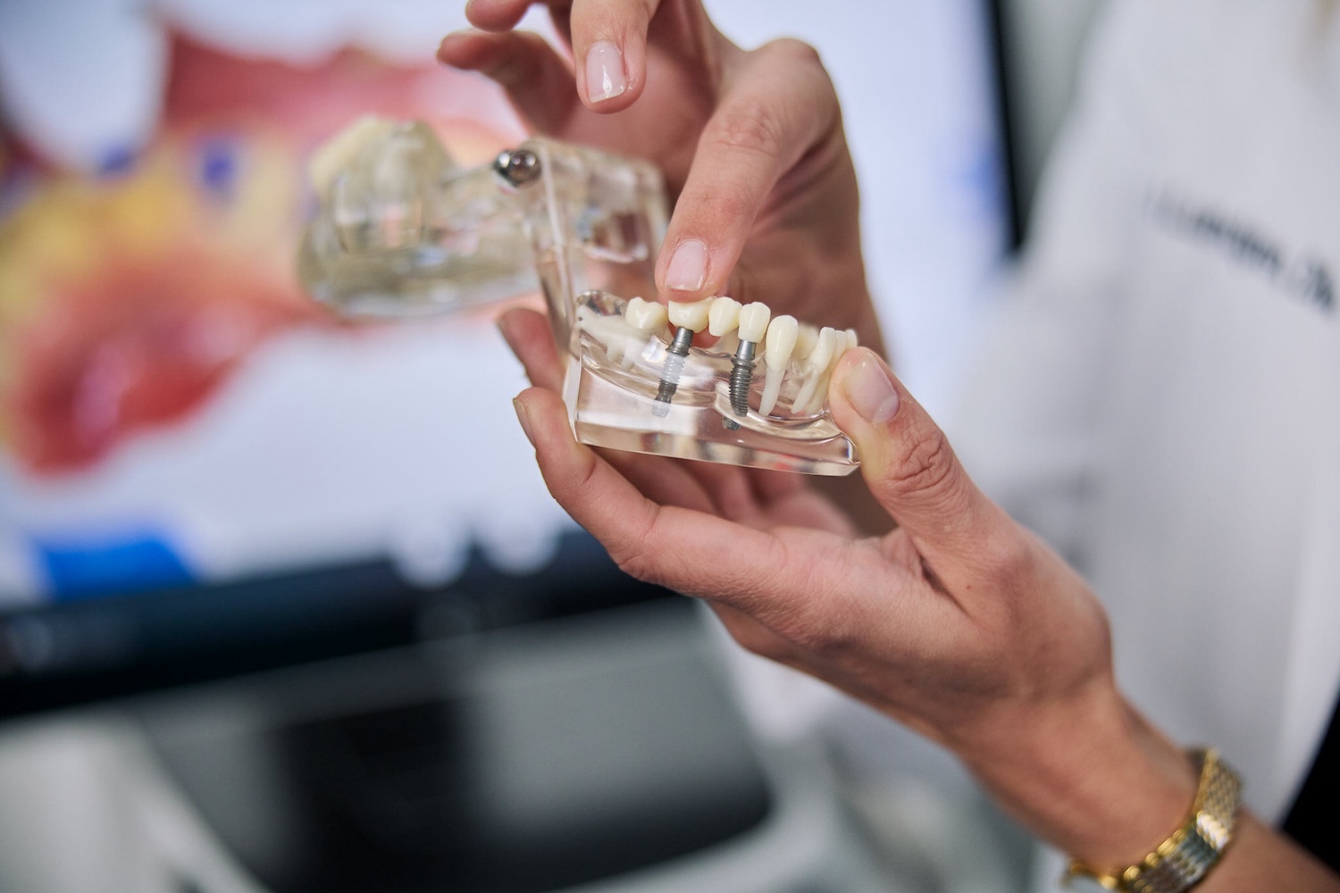 dentist using a 3-D model of dental implants