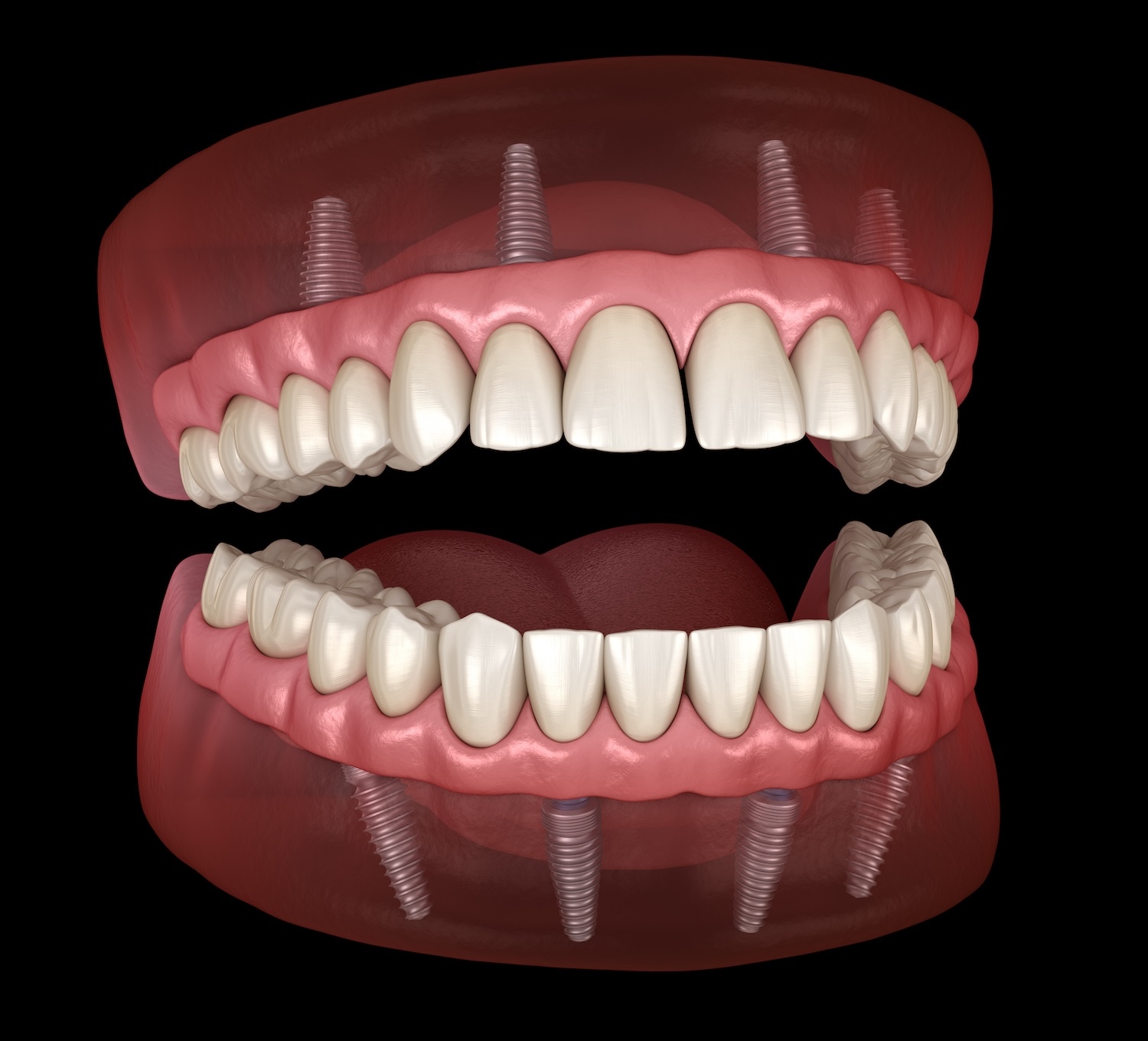 graphic illustration of all-on-4s dental implants