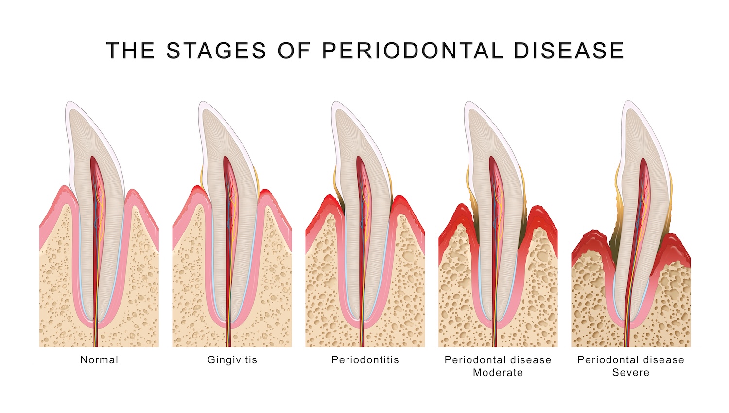 stages of periodontal disease