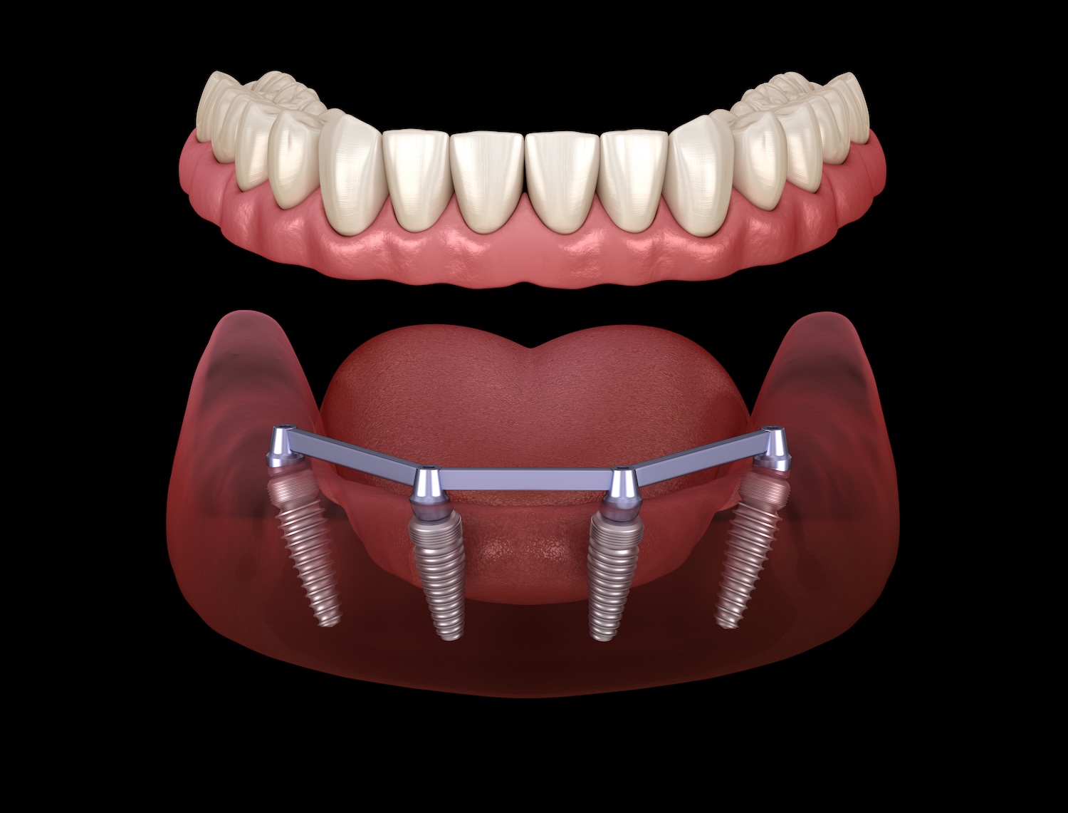 all-on-4 dentures, image of implant supported dentures