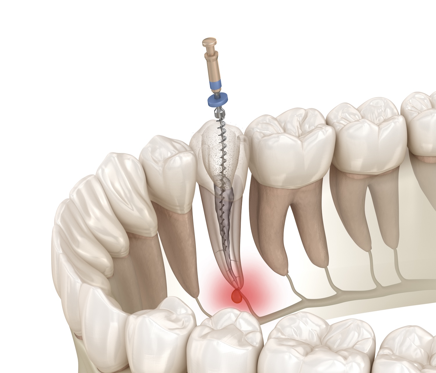 root canal, dental care, CarolinasDentist, North Carolina dentist, tooth infection, tooth pain, dental procedure, pulp infection, oral health, root canal recovery