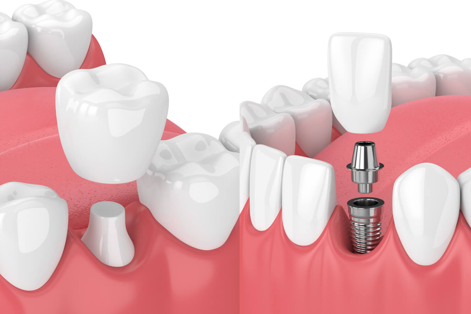 When You Need A Crown Vs Dental Implant CarolinasDentist