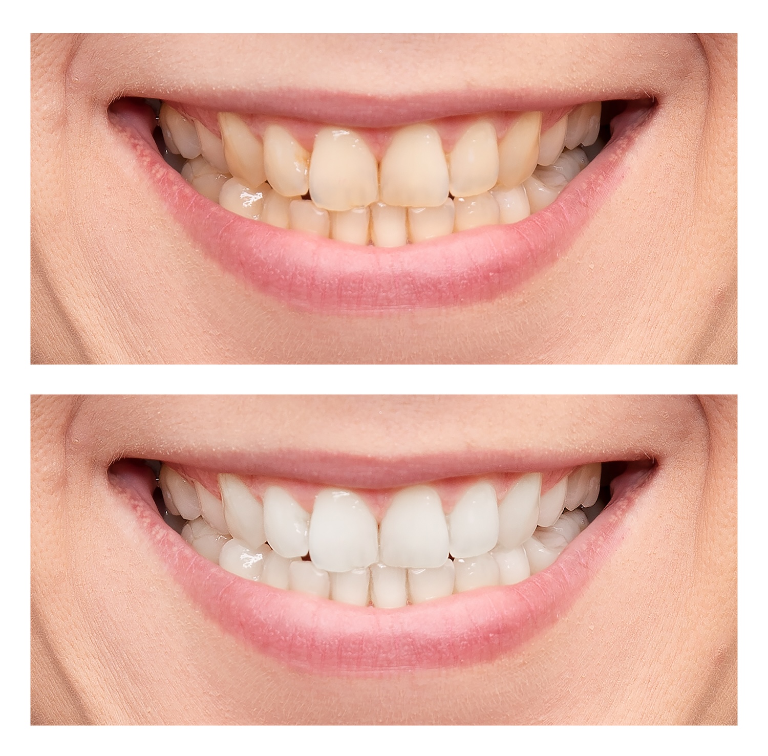 teeth whitening strips, teeth whitening, professional teeth whitening, whitening strips effectiveness, CarolinasDentist, dental health, bright smile, tooth sensitivity